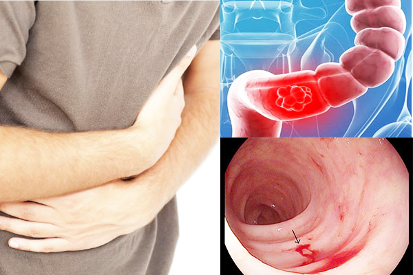 Các bệnh tương tự hội chứng ruột kích thích (IBS)