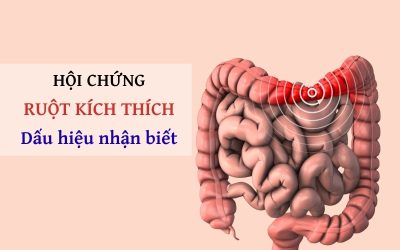 Hội chứng ruột kích thích là gì? Nguyên nhân và giải pháp toàn diện