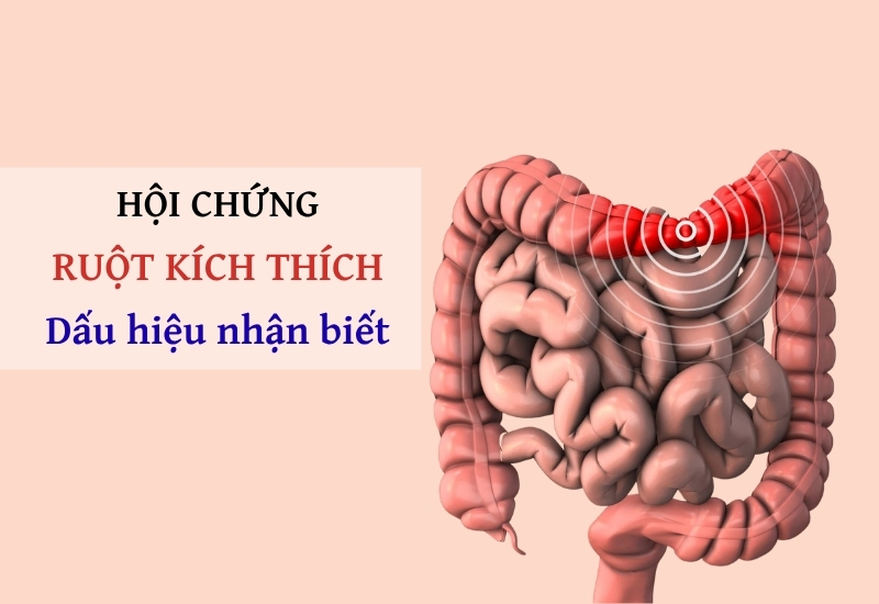 Hội chứng ruột kích thích là gì? 