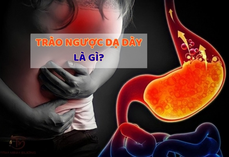 Trào ngược dạ dày là gì?