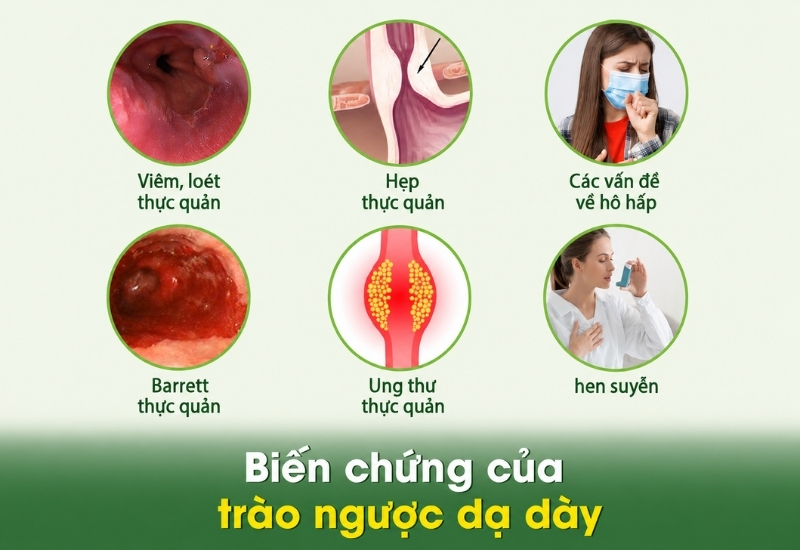 Nguyên nhân trào ngược dạ dày