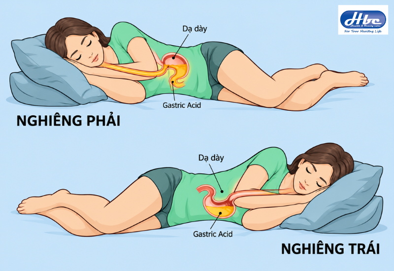 trào ngược dạ dày nằm nghiêng bên nào